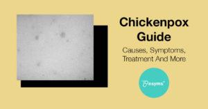 chickenpox guide