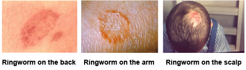 ringworm symptoms